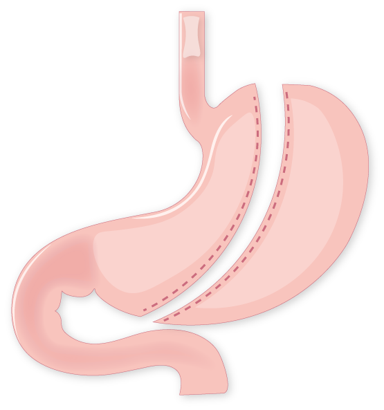 Laparoscopic Sleeve Gastrectomy – DR. M. KHRAIS CENTRE